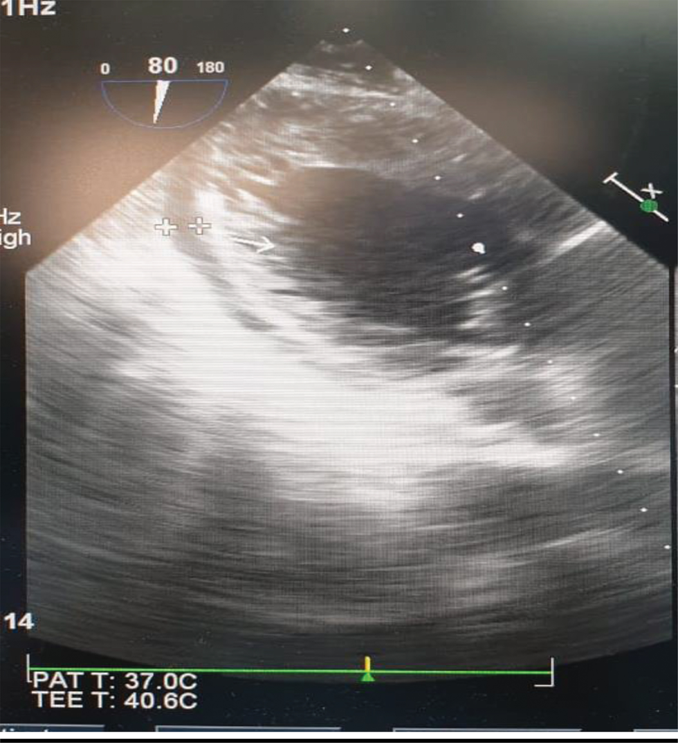 TEE showing calculation of ejection fraction (EF).