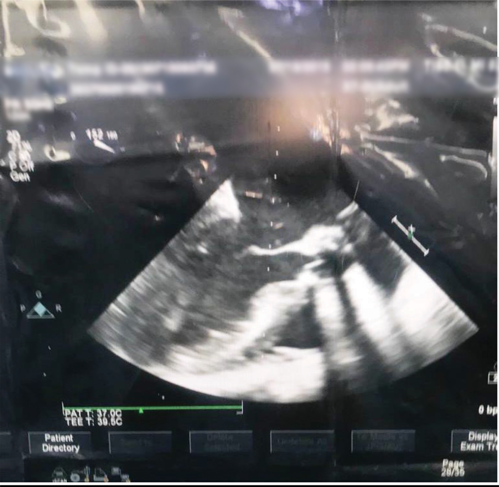 Midesophageal aortic valve long axis view showing prosthetic aortic valve with aortomitral curtain.