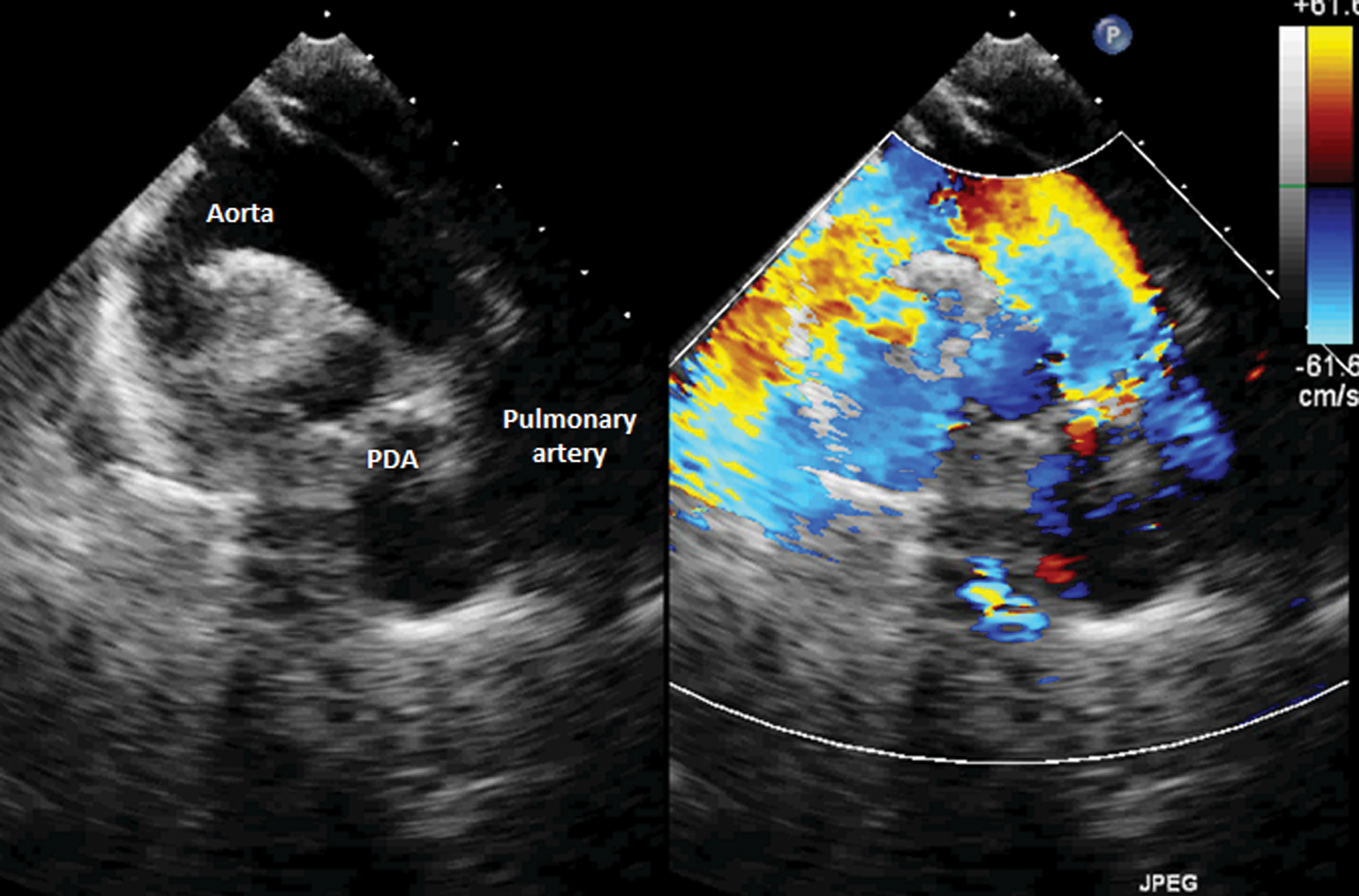 Transthoracic two-dimensional color Doppler echocardiogram showing continuous wide flow from the aorta through the ductus to the pulmonary artery.