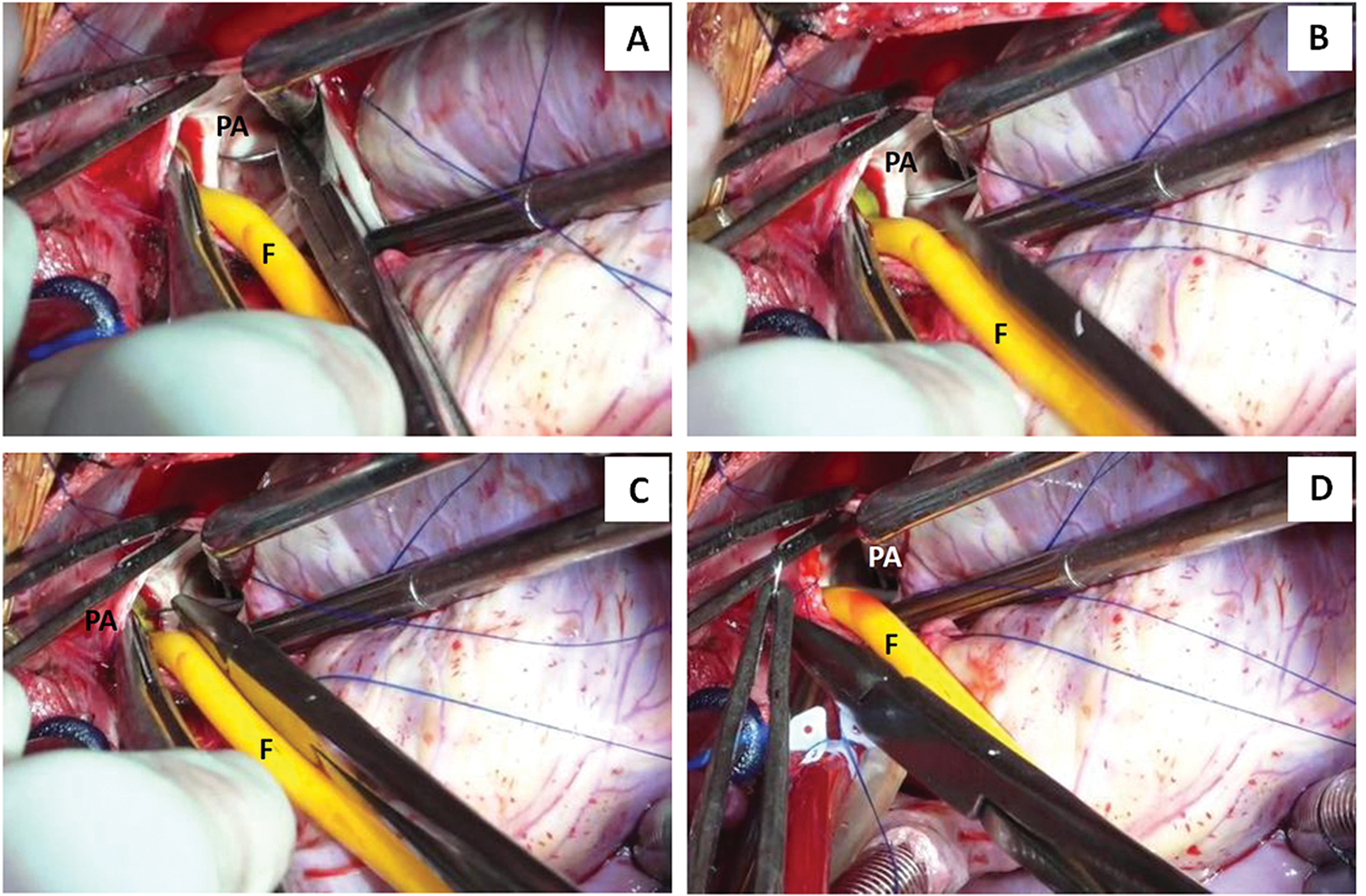 (A–D) Surgical photographs showing step-by-step transpulmonary ductal closure under normothermic cardiopulmonary bypass and cardioplegic arrest. The aorta was individually cross-clamped. After cardioplegic arrest the pulmonary trunk was transversely opened in between stay sutures. The pump flows were transiently lowered to identify the pulmonary arterial end of the ductal orifice. A 20-Fr Foley catheter was inserted through the ductal orifice into the aorta. The ductal orifice was closed using multiple interrupted 4-0polypropylene suture buttressed with Teflon pledgets. The Foley catheter was advanced little deep within the aorta to avoid balloon rupture during suture placement. The balloon subsequently was deflated and withdrawn.
