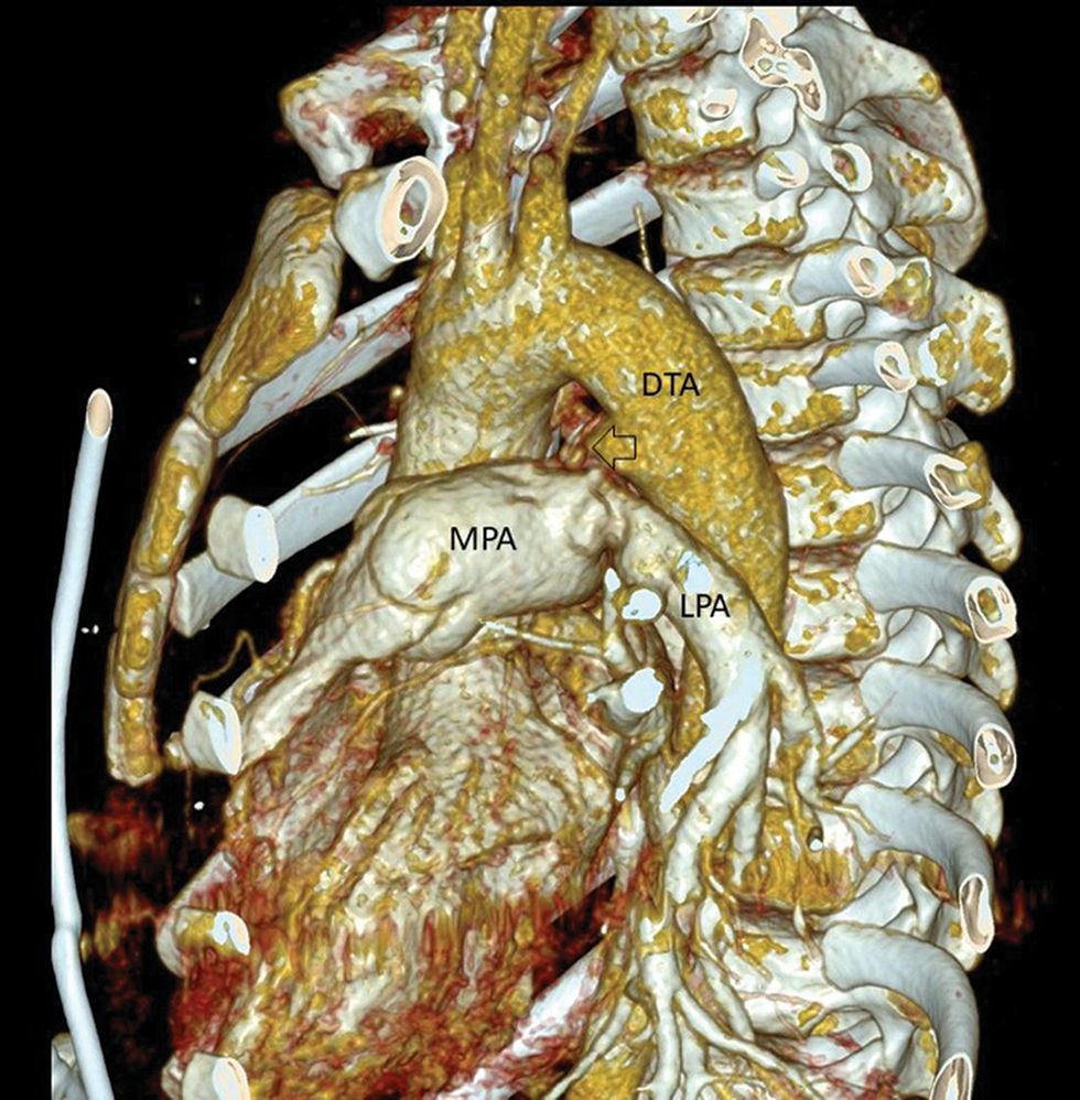 Sagittal oblique computerized tomographic image showing the closed ductus arteriosus (arrow) with no flow between the aorta and pulmonary artery. DTA, descending thoracic aorta; LPA, left pulmonary artery; MPA, main pulmonary artery.