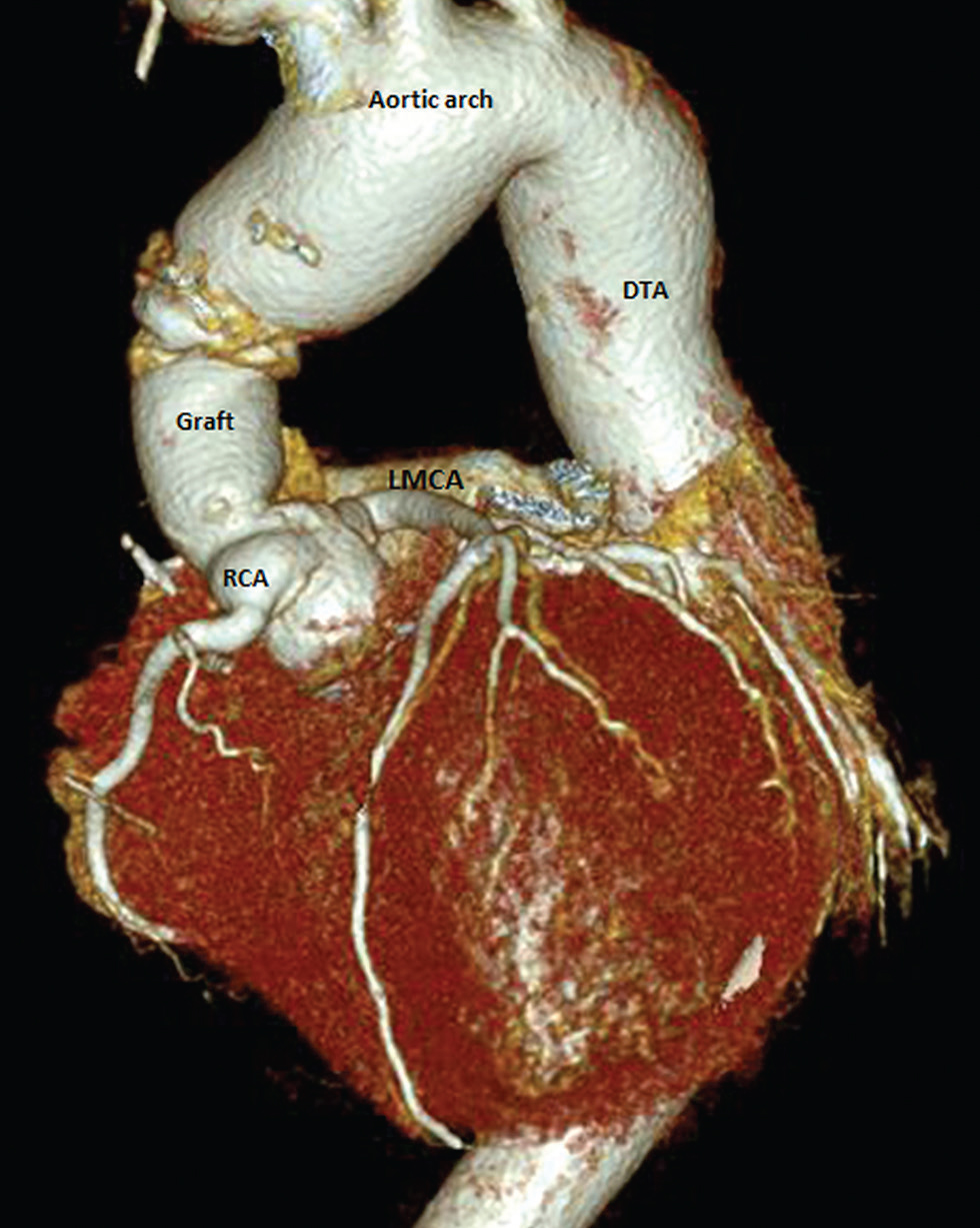 Postoperative computerized volume rendered image revealed widely patent left and right coronary arterial systems, intact proximal and distal anastomoses. DTA, descending thoracic aorta; LMCA, left main coronary artery; RCA, right coronary artery.