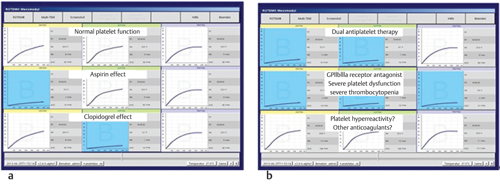 (a,b) Showing platelet aggregometry graphs (on ROTEM platelet analyzer) for normal platelet function, aspirin clopidogrel, GP II b IIIa thrombocyte, effects, and platelet hyperactivity curves.