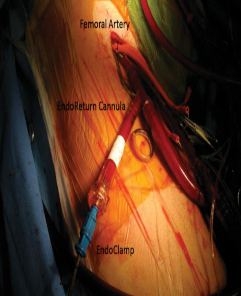 Endoaortic balloon clamp—balloon-tipped catheter, inserted through the femoral artery positioned in the ascending aorta.