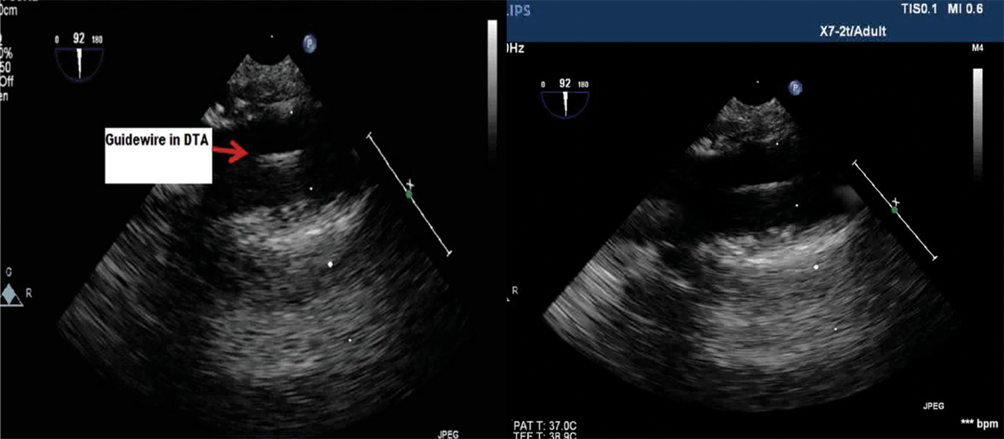 Transesophageal echocardiography (TEE)upper esophageal long axis view showing femoral artery cannulation with the guidewire being visualized the descending aorta.