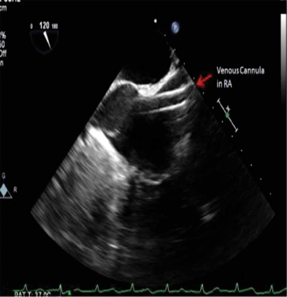 Transesophageal echocardiography (TEE) mid-esophageal bicaval view—SVC cannulation with tip of the guidewire visualized in RA.