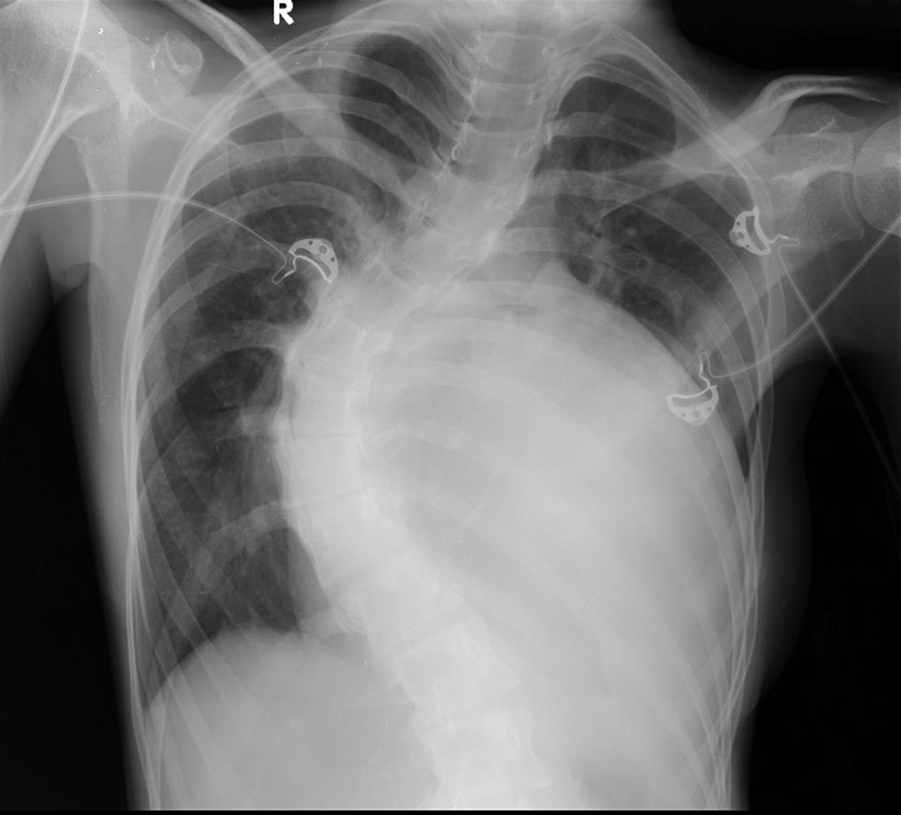 Chest X-ray showing severe scoliosis.