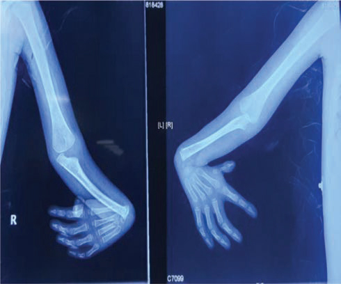 Radiograph of both the upper limbs showing congenital absence of both the radius and presence of both the thumbs.