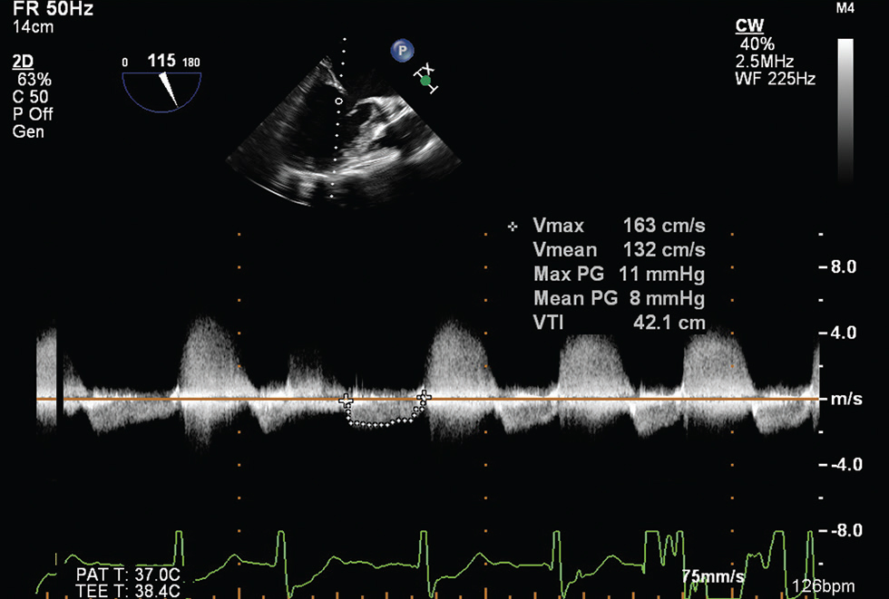 Two-dimensional midesophageal long axis transesophageal echocardiographic view at 115 degrees, showing a mean pressure gradient of 8 mm Hg across the mitral valve.