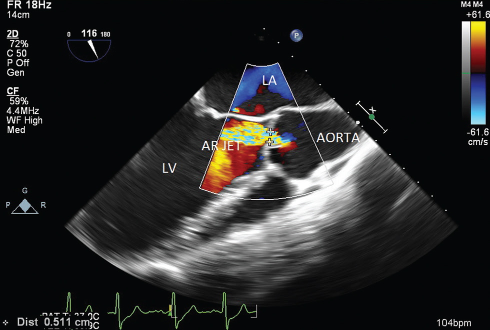 Two-dimensional midesophageal aortic valve long axis transesophageal echocardiographic view at 116 degrees, showing aortic valve regurgitation with a vena contracta of 0.51 cm. Abbreviations: LA, left atrium; LV; left ventricle; AR, aortic regurgitation.