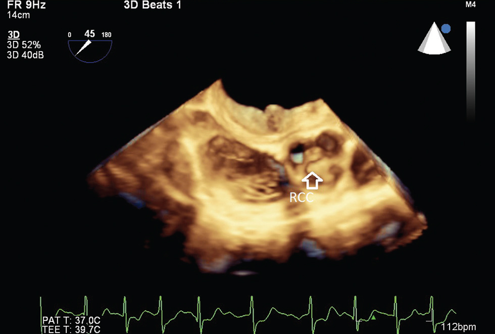 Three-dimensional midesophageal aortic valve short axis transesophageal echocardiographic view, showing prolapse of RCC. Abbreviation: RCC, right coronary cusp.