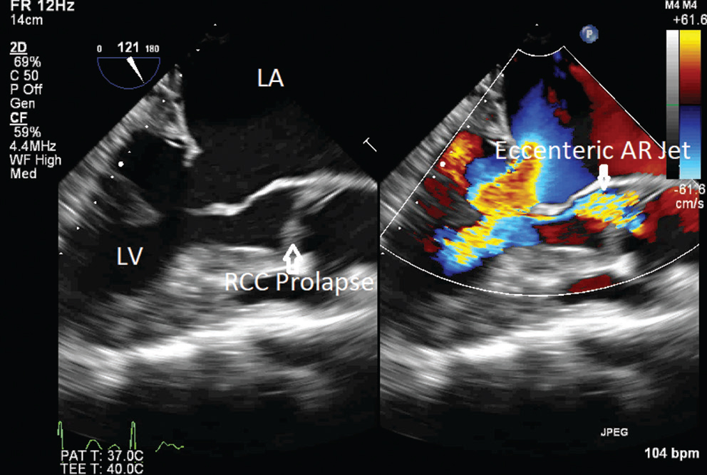 Two-dimensional midesophageal aortic valve long axis transesophageal echocardiographic view at 121 degrees, showing aortic valve eccentric regurgitation jet with RCC prolapse. Abbreviations: LA, left atrium; LV, left ventricle; AR, aortic regurgitation; RCC, right coronary cusp.