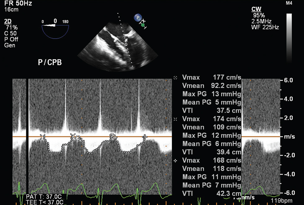 Two-dimensional midesophageal four chamber transesophageal echocardiographic view at 0 degrees post first cardiopulmonary bypass, showing average mean gradients of three beats across mitral valve of 6 mm Hg.