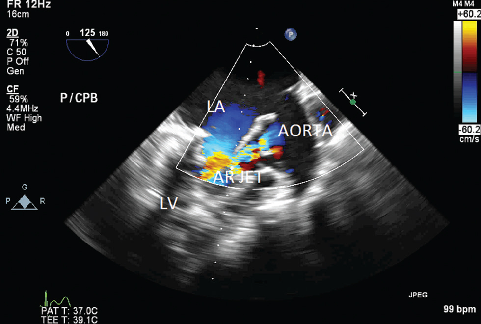 Two-dimensional midesophageal aortic valve long axis transesophageal echocardiographic view at 125 degrees, showing moderate residual regurgitant jet across aortic valve. Abbreviations: LA, left atrium; LV, left ventricle; AR, aortic regurgitation.