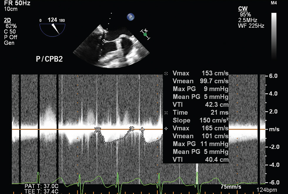 Two-dimensional midesophageal long axis transesophageal echocardiographic view at 124 degrees,, showing average of two beats mean mitral valve gradient of 5 mm Hg.