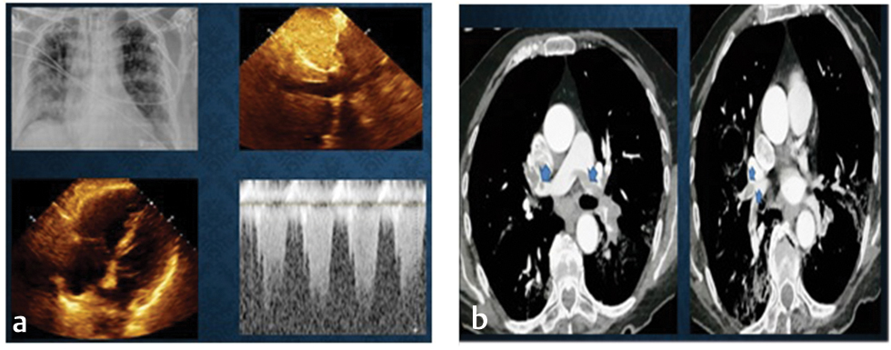 Chest X-ray depicting bilateral interstitial infiltrates. Rapid echocardiogram showed dilated RV and IVC, and TR jet PASP > 40 mm Hg. Diagnosis of acute pulmonary embolism was made, which was confirmed with CT scan as (a) revealed ground glass opacities and pulmonary thrombi bilateral (blue arrows), detected up to segmental branches. Abbreviations: IVC, inferior vena cava; PASP, pulmonary artery systolic pressure; RV, right ventricle.