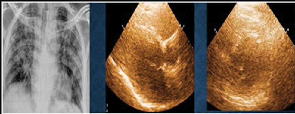 Chest X-ray revealed B/L consolidation. Echocardiography revealed normal LV function. Abbreviation: LV, left ventricle.
