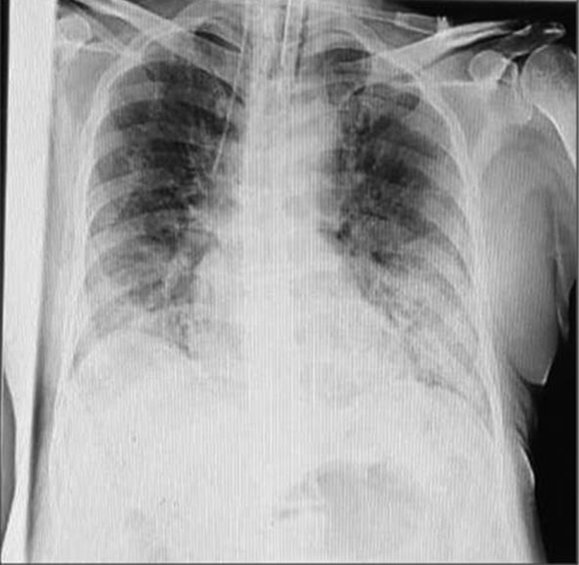 X-ray of COVID-19 positive case.