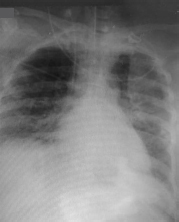 Chest X-ray on admission to our intensive care unit showing homogeneous opacity in almost whole of left lung and middle and lower lobes of right lung.