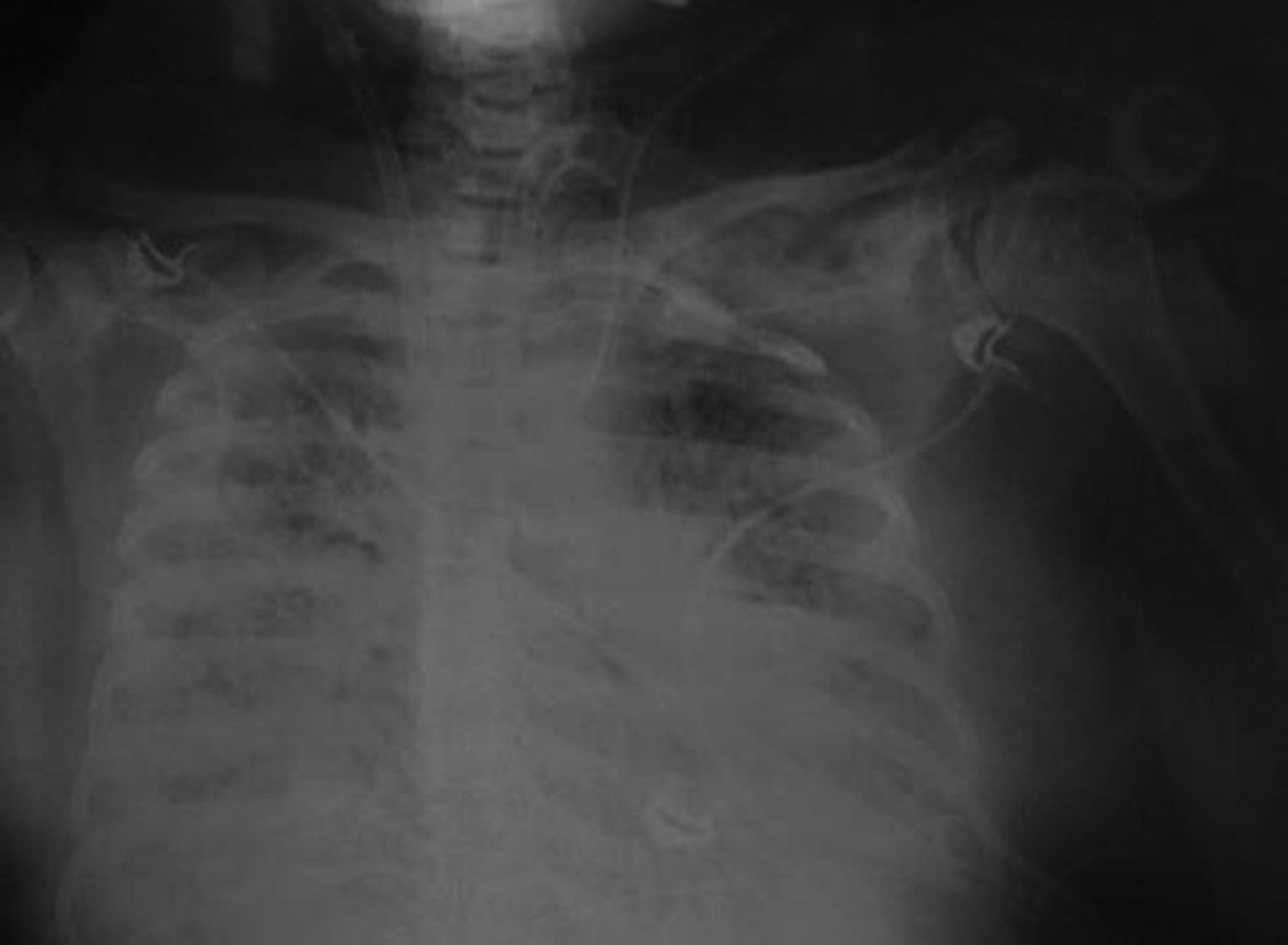 Chest X-ray on Day 8 of intensive care unit admission—extracorporeal membrane oxygenation instituted.