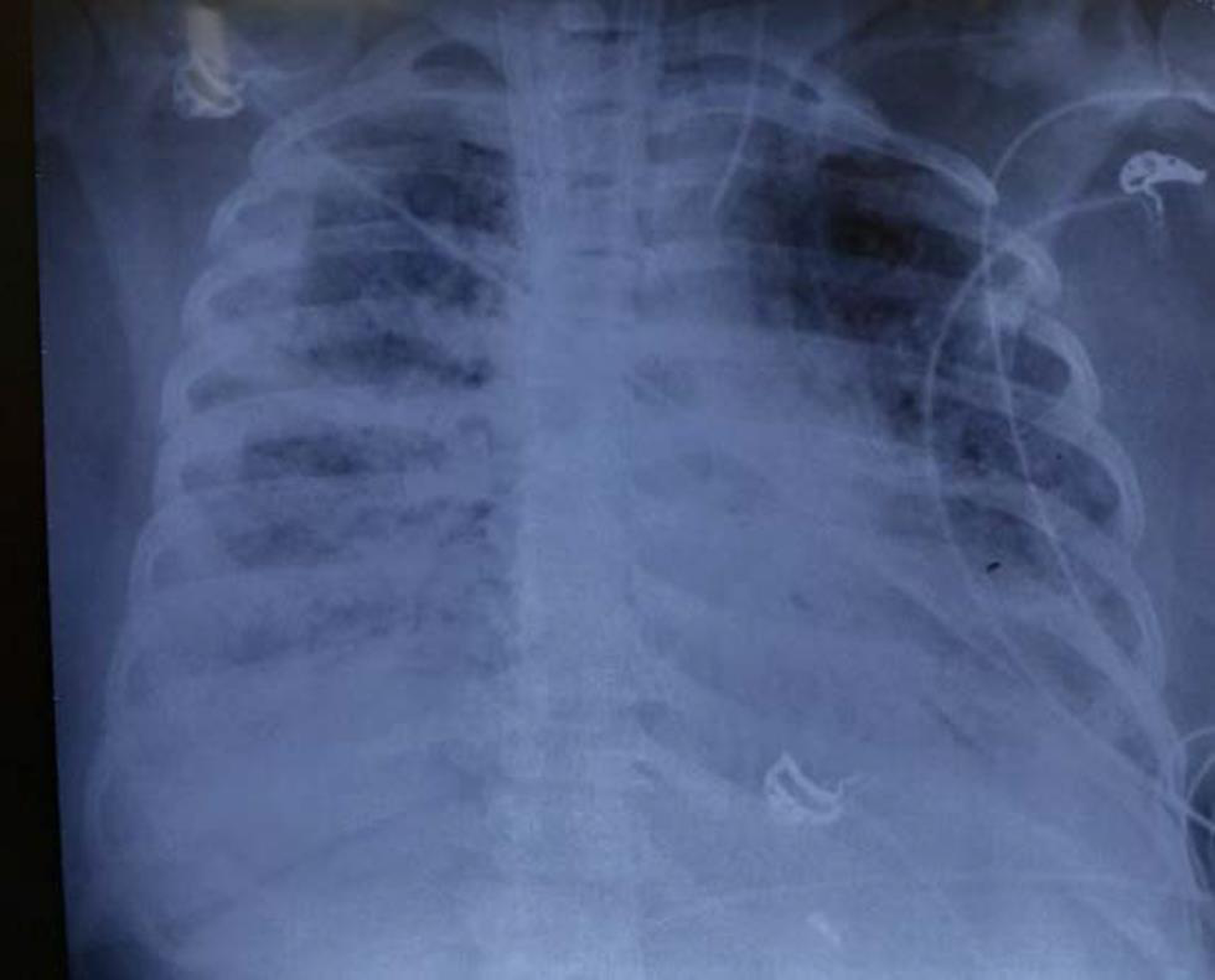 Chest X-ray on Day 33 extracorporeal membrane oxygenation—looking as if very little improvement in upper lobe of left lung parenchyma.