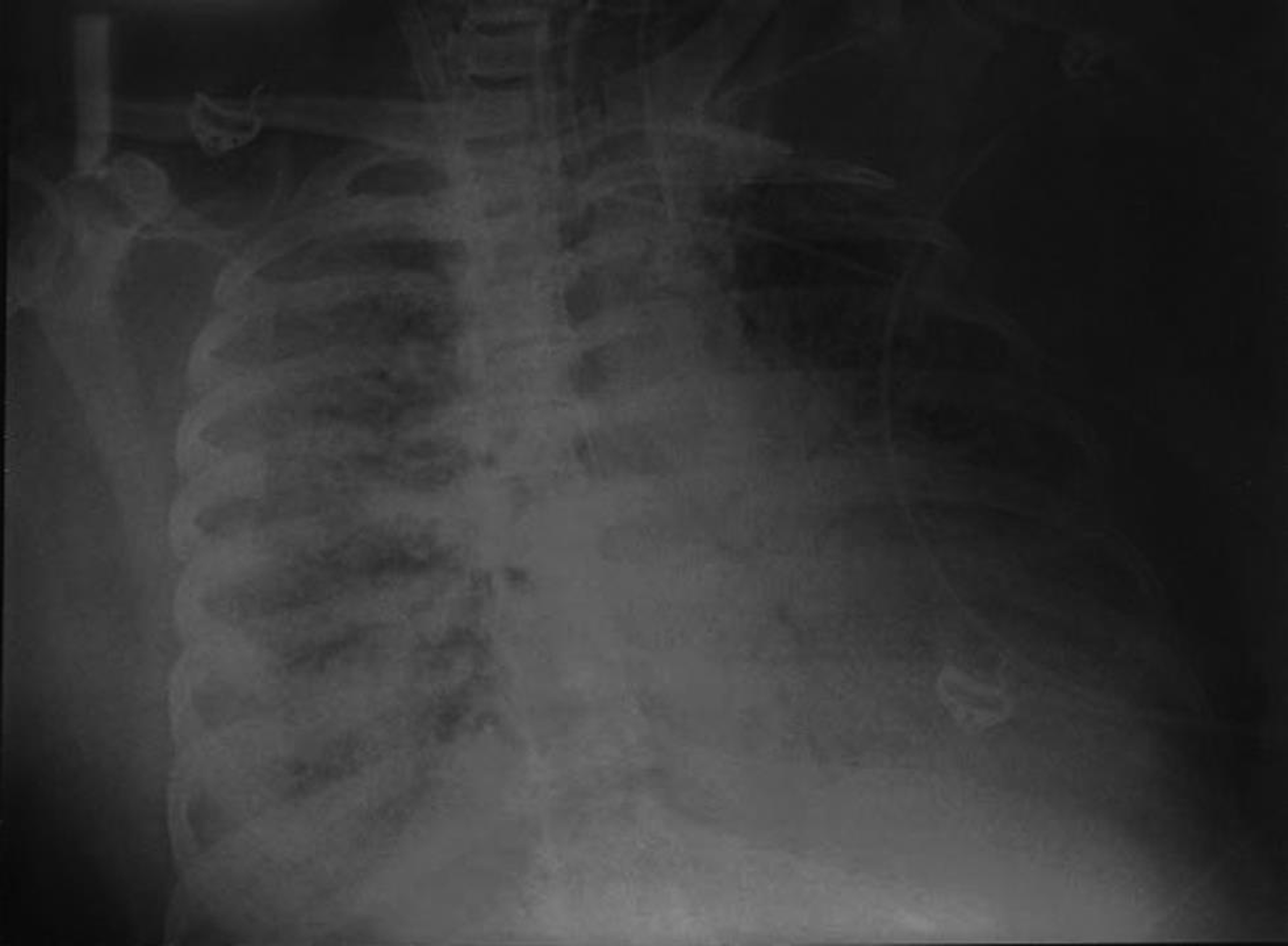 Chest X-ray on Day 40 extracorporeal membrane oxygenation—again deteriorated from the previous little improvement.