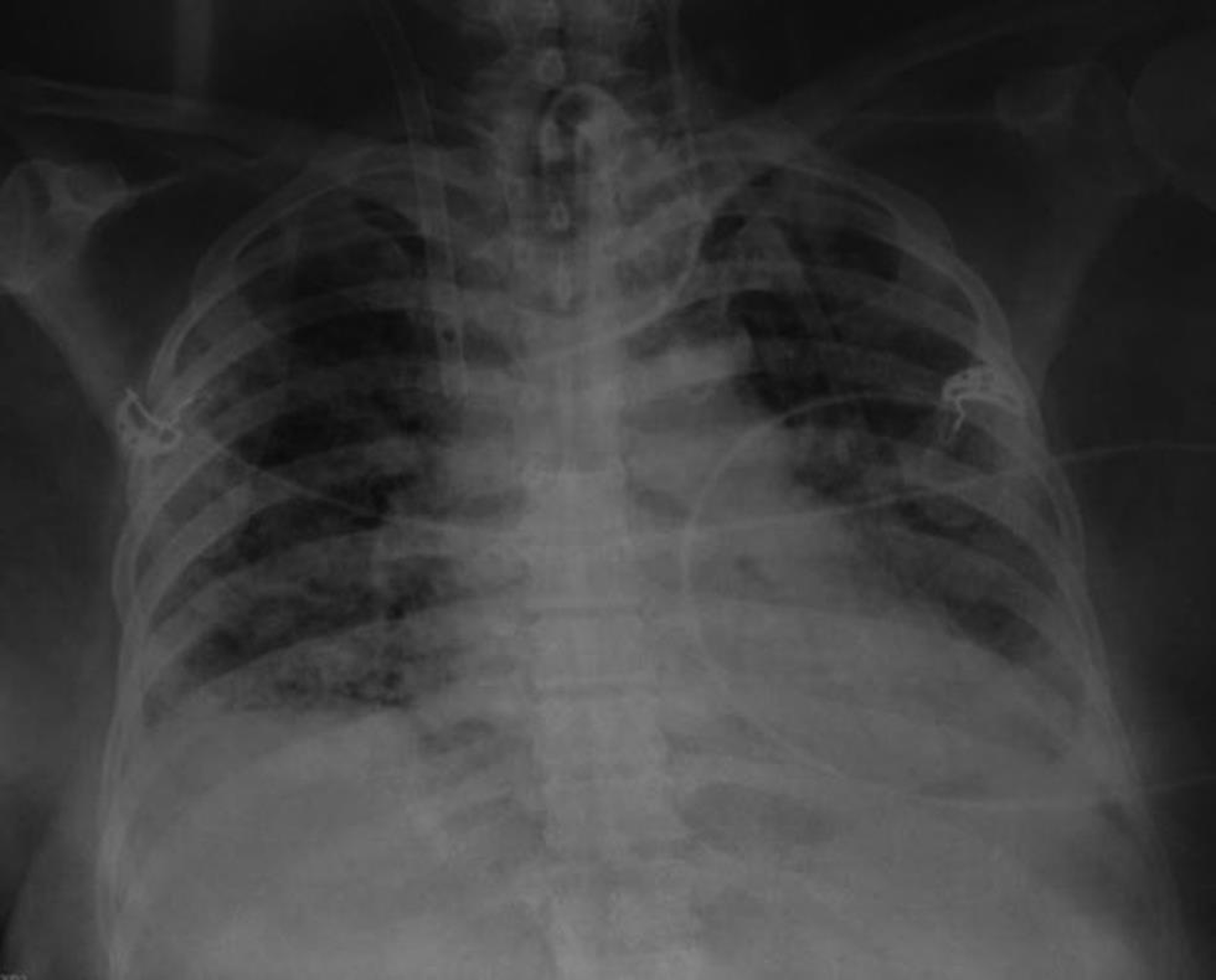 Chest X-ray on 86th Day of extracorporeal membrane oxygenation showing slow beginning of resolution of acute respiratory distress syndrome.