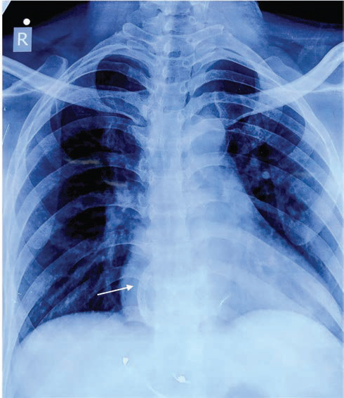 Chest X-ray showing Amplatzer atrial septal defect occluder device (arrow) in right atrium.