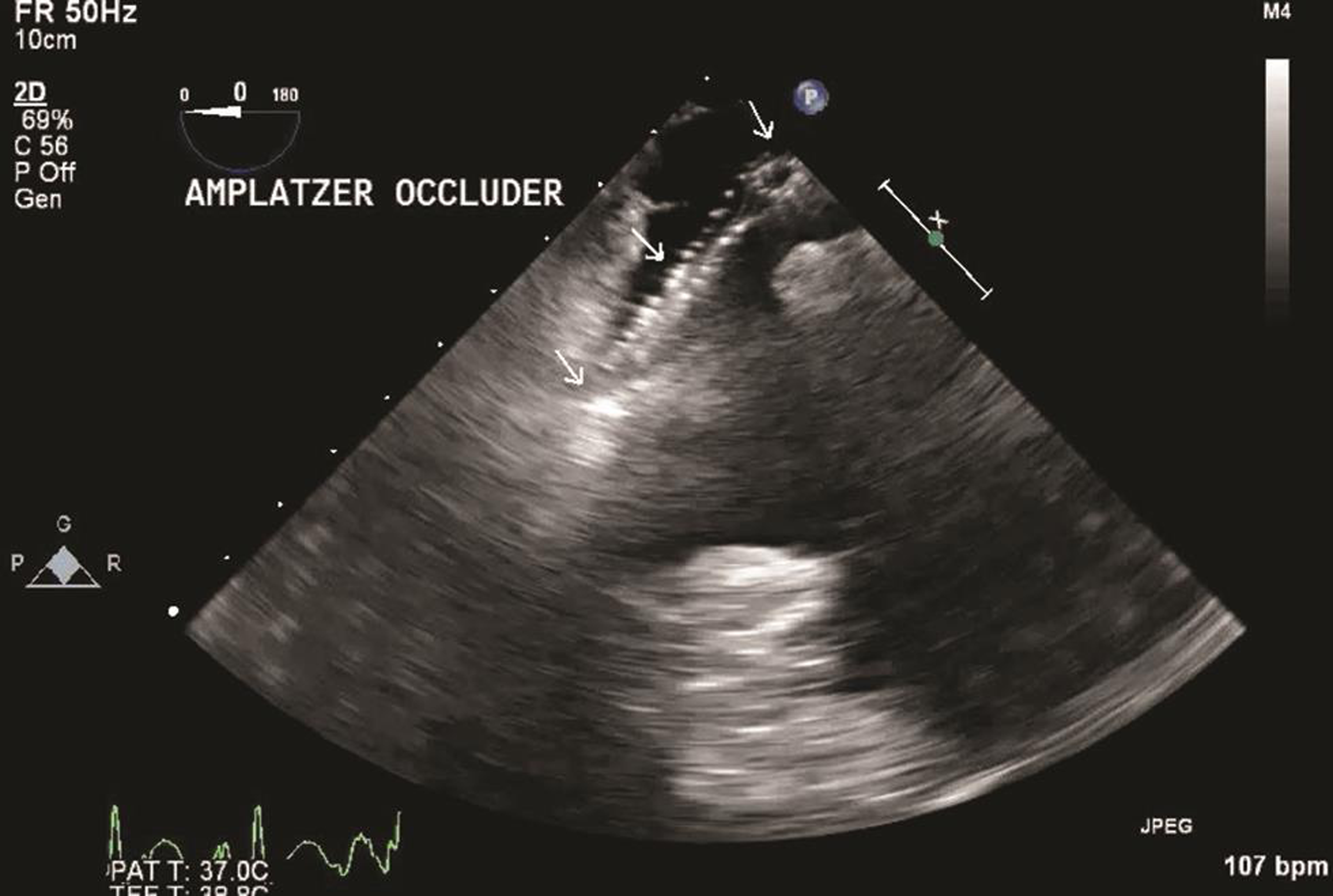 Transesophageal echocardiography midesophageal four-chamber view (probe tilted to right), showing Amplatzer atrial septal device occluder in right atrium and atrial septal defect.