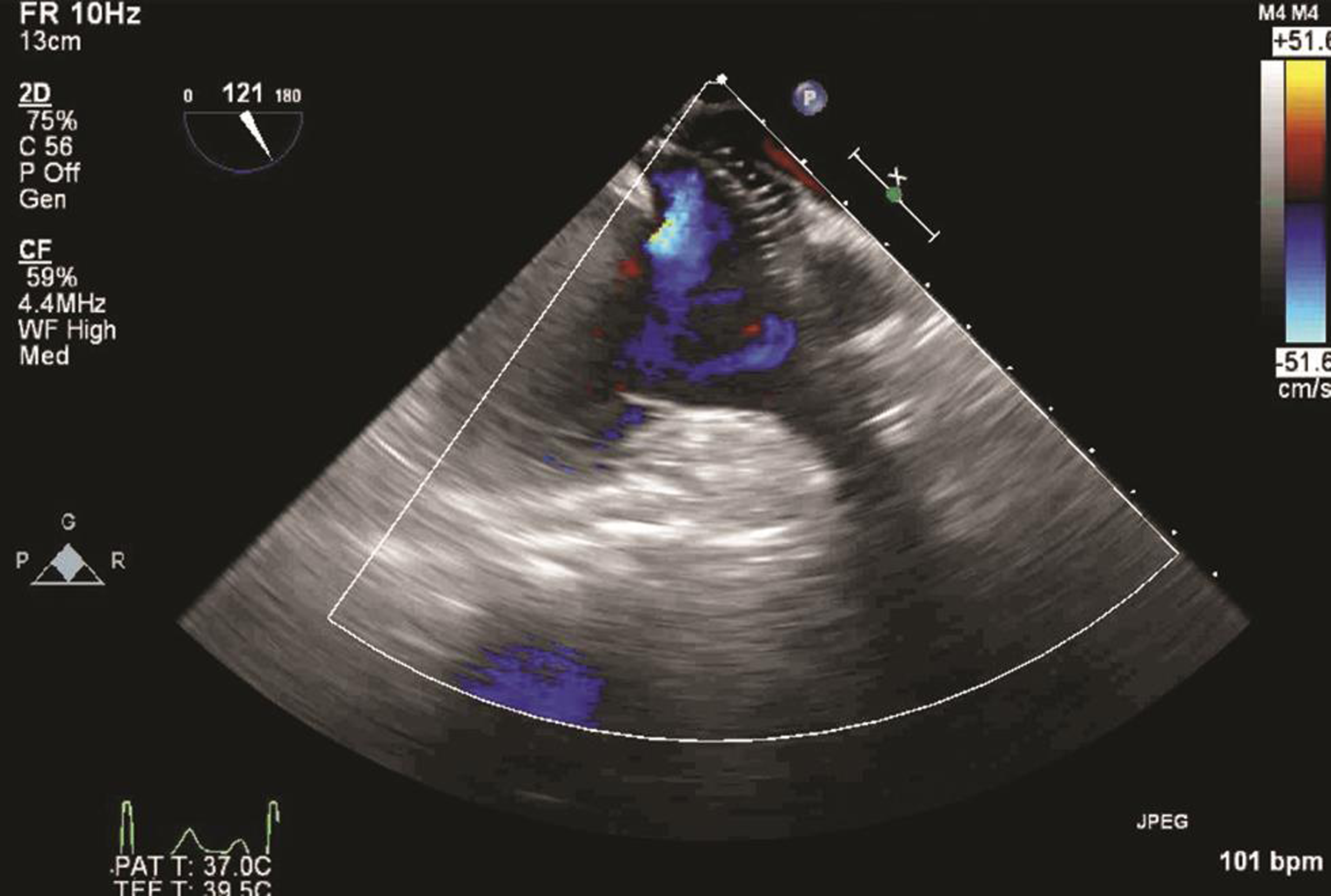 Transesophageal echocardiography midesophageal modified bicaval view, showing dislodged atrial septal defect device occluder.