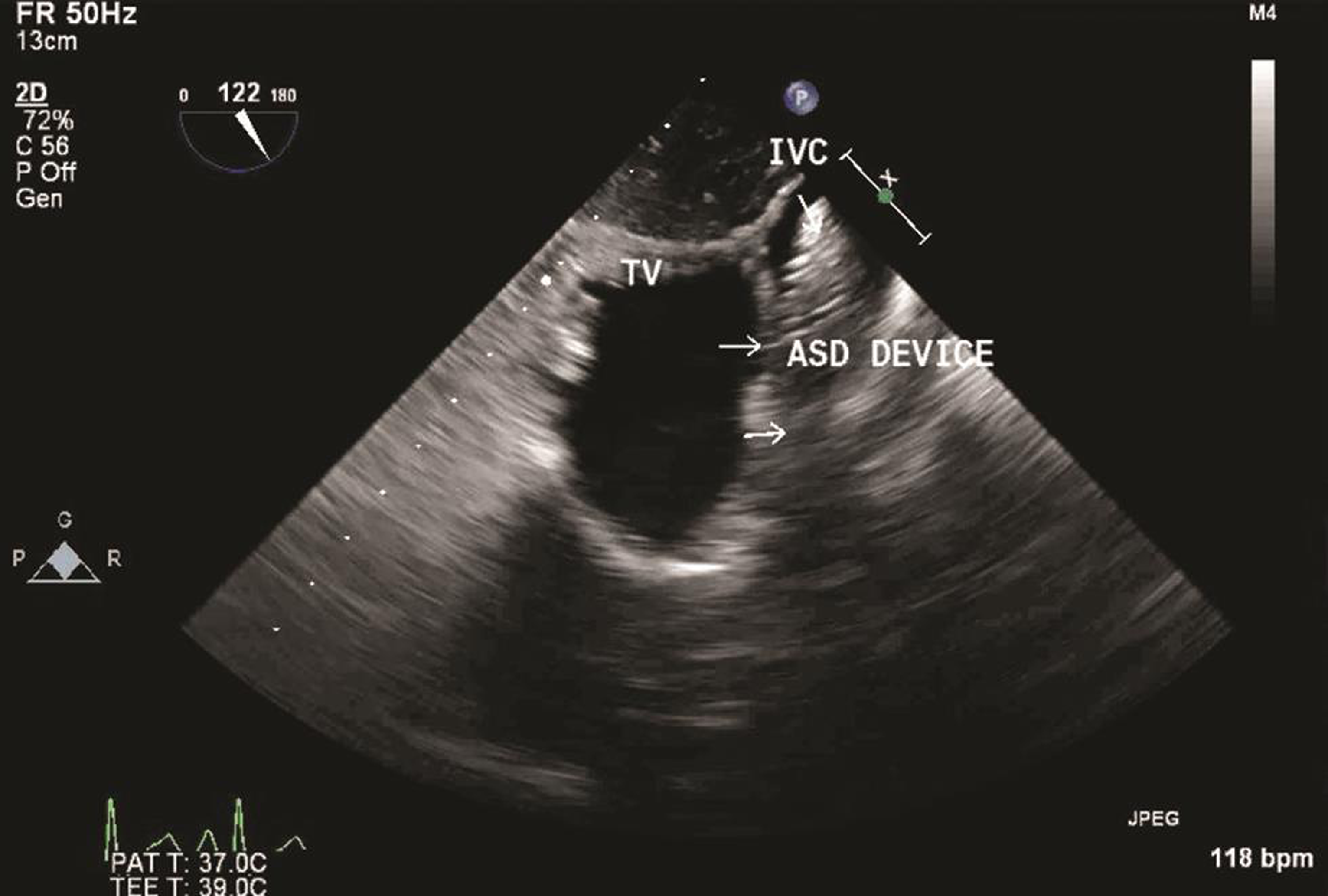 Transesophageal echocardiography transgastric right ventricle inflow–outflow view, showing impingement of atrial septal defect (ASD) device occluder on IVC right atrium junction. Abbreviations: ASD, atrial septal defect; IVC, inferior vena cava.