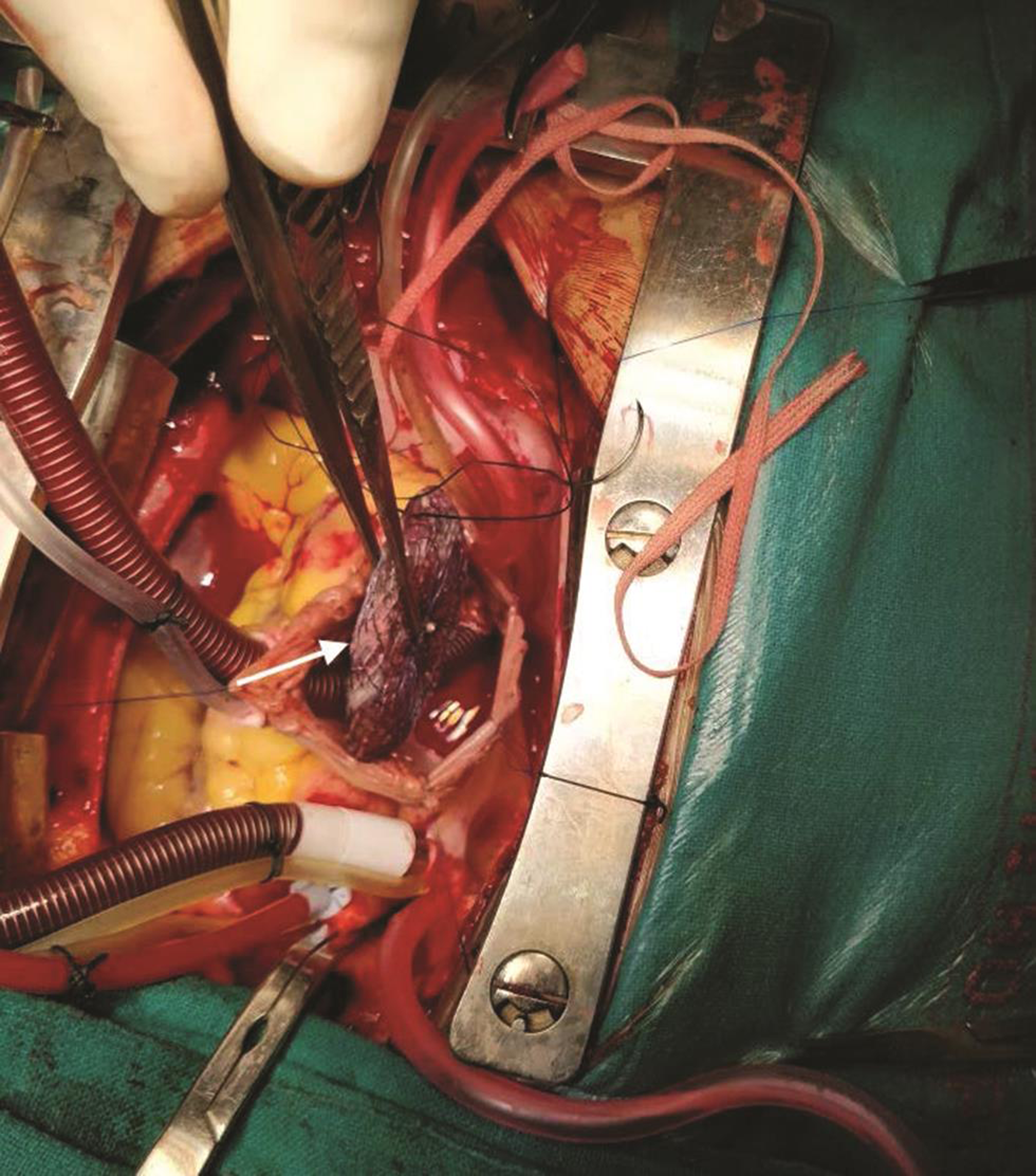 Surgical retrieval of Amplatzer atrial septal defect device occluder (arrow).