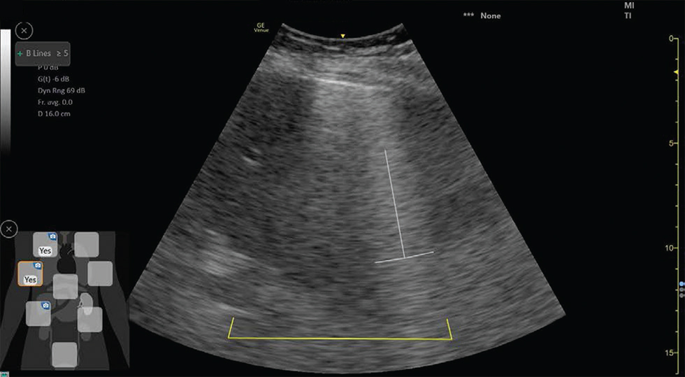 B line scoring using ultrasound machine with artificial intelligence in a 72-year-old female coronavirus disease 2019 suspected patient (B lines >5).