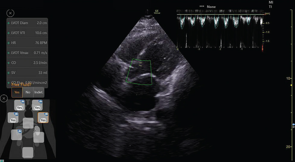 Auto-velocity time integral and cardiac output using ultrasound machine with artificial intelligence in a 72-year-old female coronavirus disease 2019 suspected patient (cardiac output: 2.5 L/min, left ventricular velocity time integral: 10.6 cm).