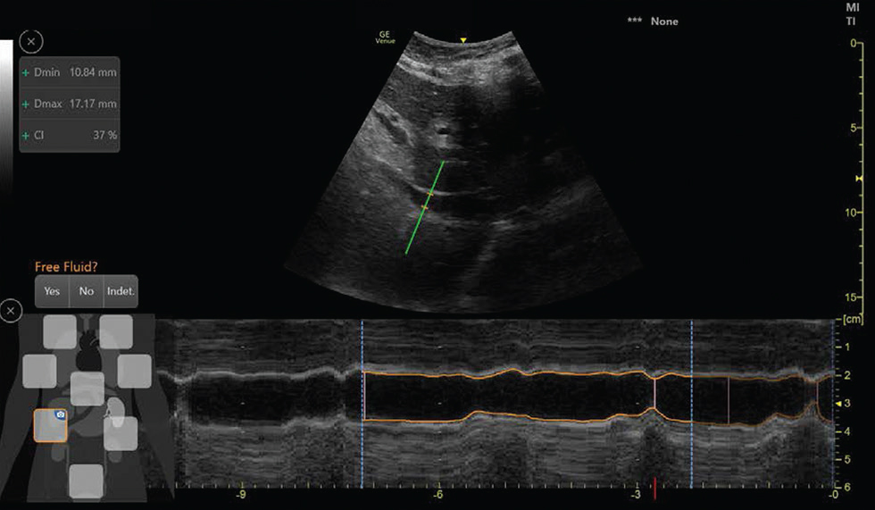 Auto-inferior vena cava collapsibility index calculation using ultrasound machine with artificial intelligence in a 72-year-old female coronavirus disease 2019 suspected patient (inferior vena cava maximum diameter: 1.71 cm, minimum diameter: 1.08 cm, collapsibility index: 37%).