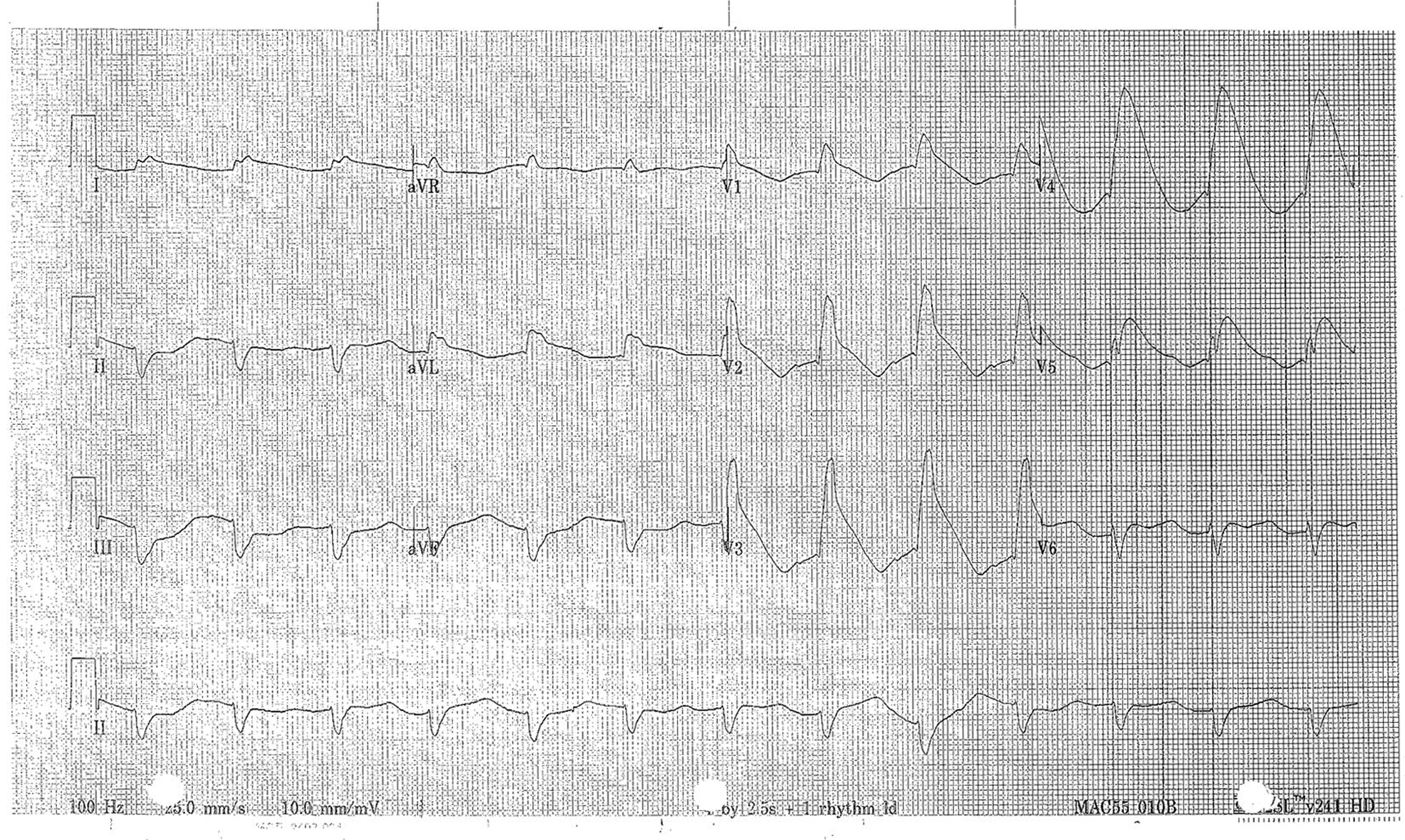 Electrocardiogram from day 5 demonstrating diffuse ST elevation and QTc prolongation