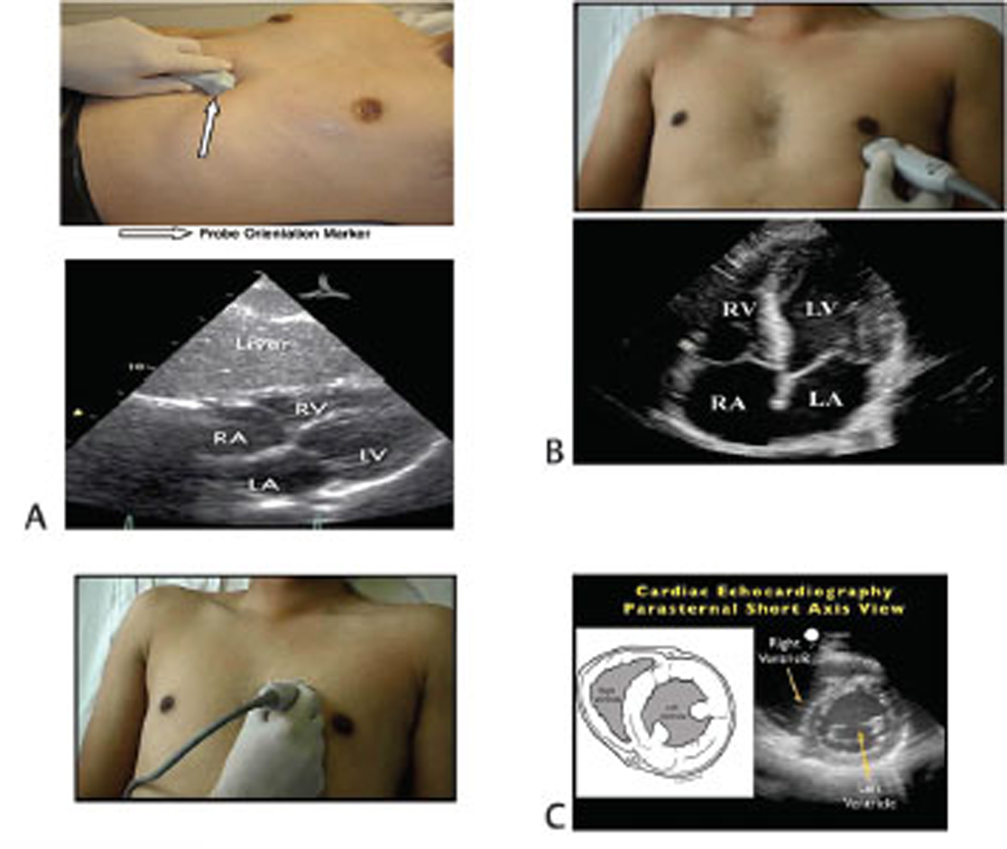 Transthoracic ecocardiography for catheter tip confirmation. (A) Subcostal view. (B) Apical four chamber view. (C) Parasternal short axis view.