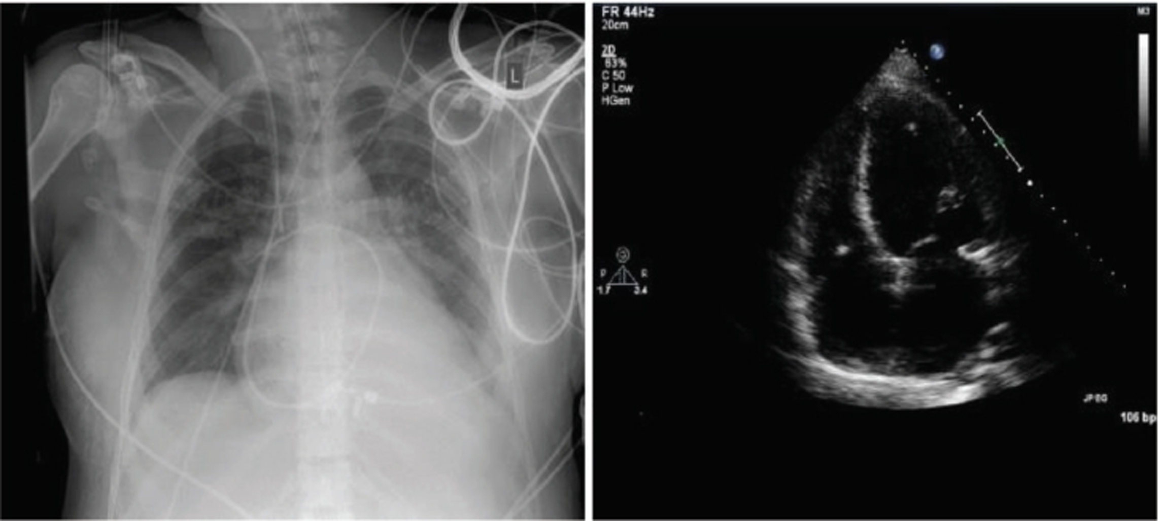 Postpartum cardiomyopathy X-ray chest and echocardiography showing pulmonary edema and right ventricular (RV) strain.