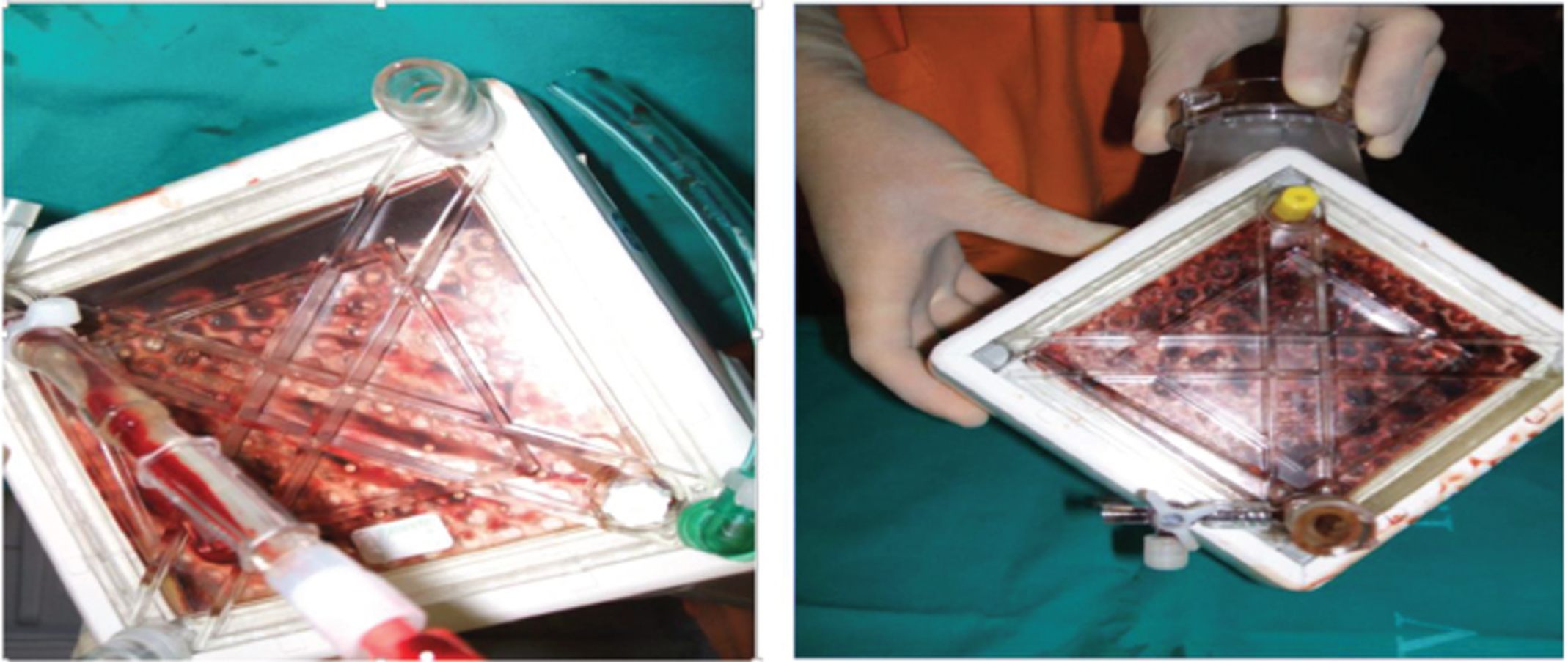 Clotting of oxygenator as seen enface with a torch on the maquet quadrox oxygenator of the extracorporeal membrane oxygenation (ECMO) circuit.