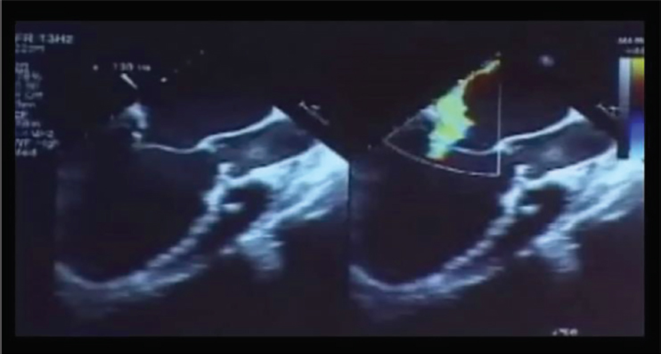 Patient on venoarterial (VA) extracorporeal membrane oxygenation (ECMO) for severe systolic and diastolic mitral regurgitation (MR).