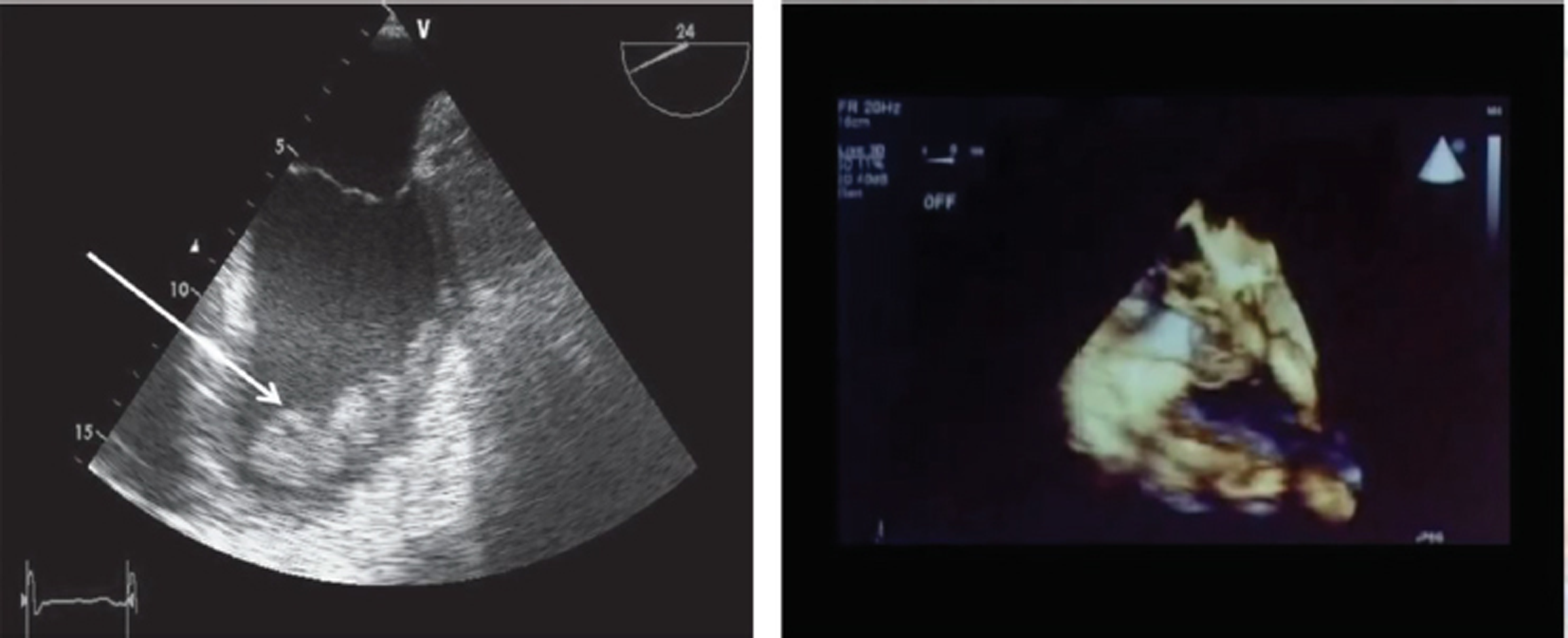 Extracorporeal membrane oxygenation (ECMO) complications—thrombosis on 3D echocardiography are well visualised.