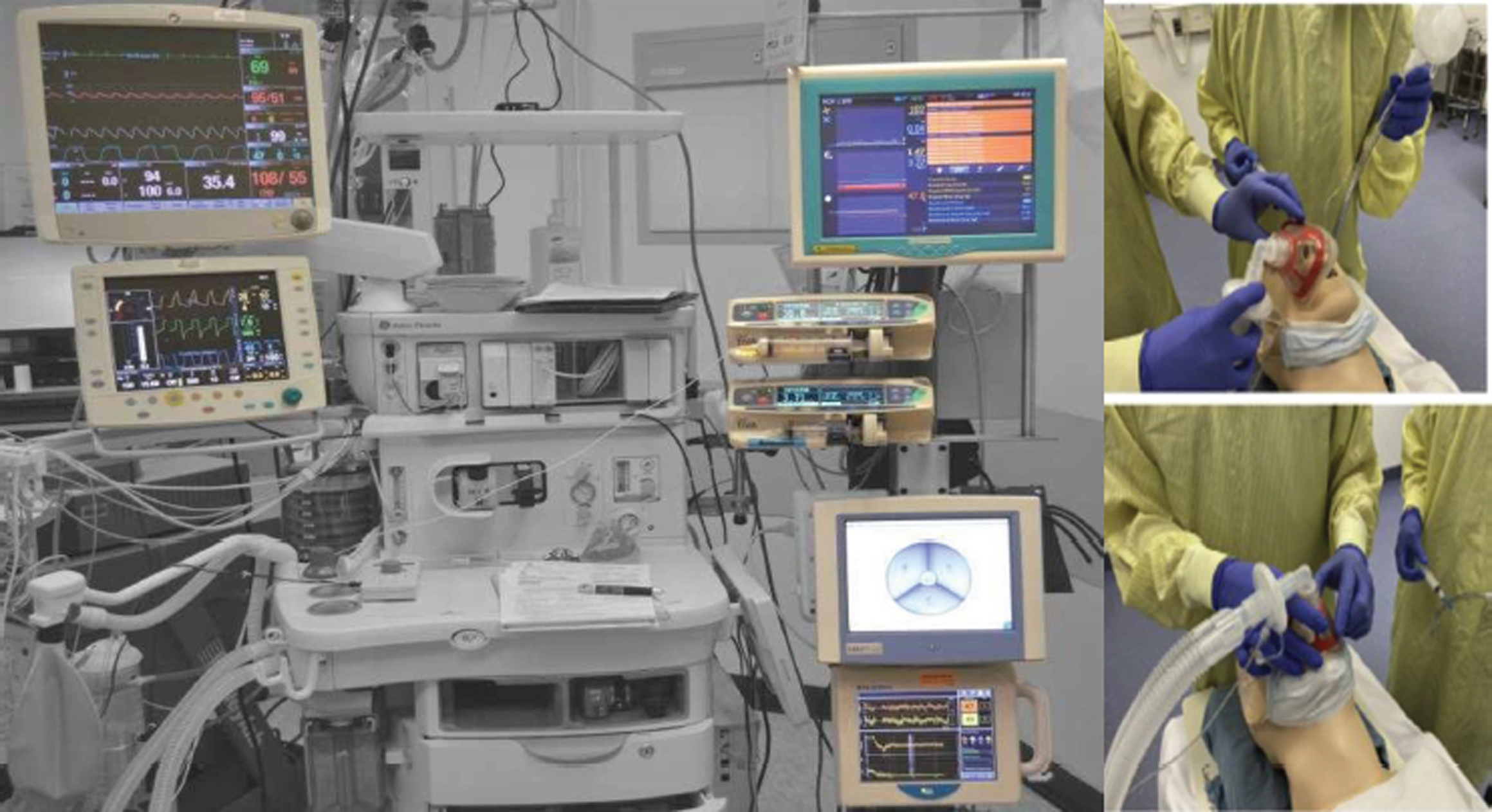 An array of TIVA infusion pumps with the anaesthesia machine and monitors using intubations and for safe extubation too!