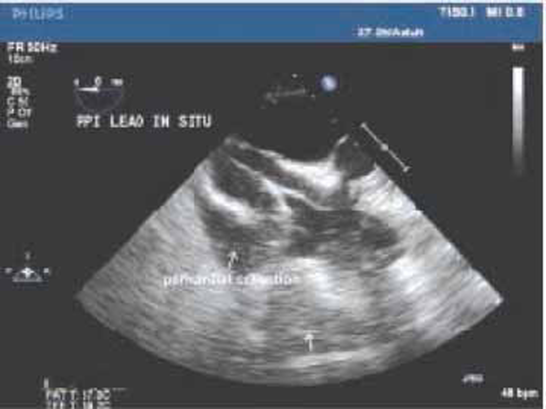 Midesophageal 4-chamber view showing multiple pacing wires and pericardial collection.