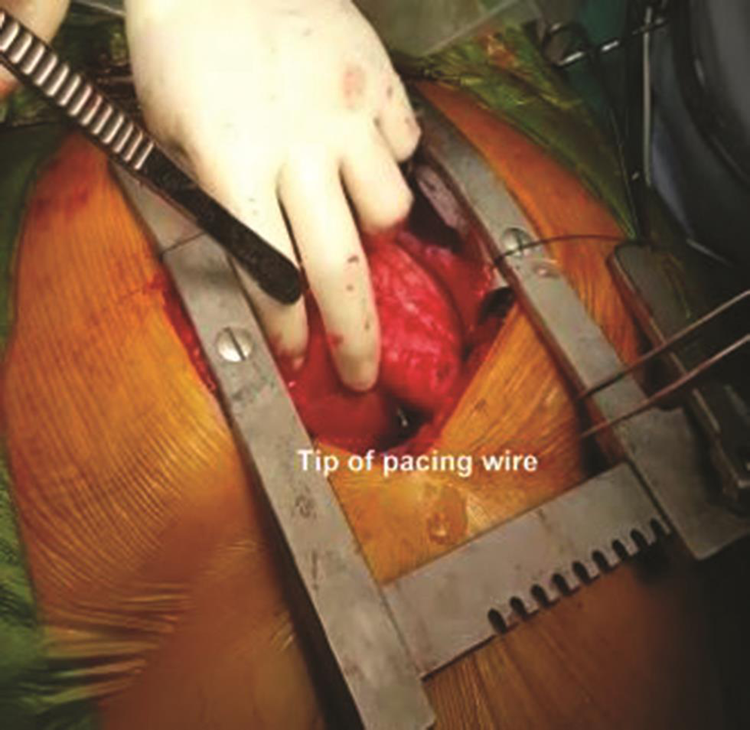 After pericardial opening pacing, wire was found to be perforating right ventricle (RV).