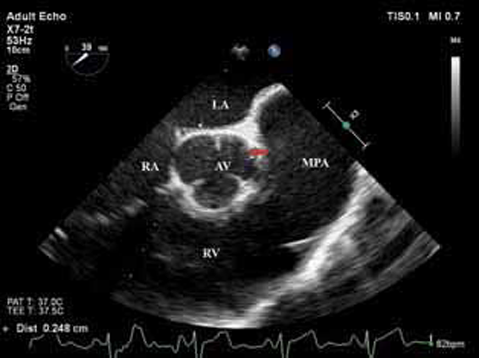 Two-dimensional transesophageal echocardiography (2D TEE), midesophageal aortic valve short axis (SA) view, showed narrowing of left main coronary artery (LMCA). LA, left atrium; RA, right atrium; AV, aortic valve; RV, right ventricle; MPA, main pulmonary artery.