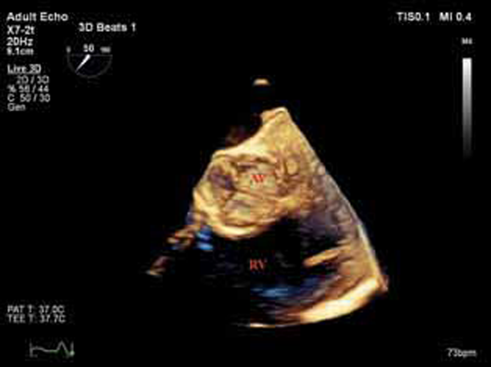 Three-dimensional transesophageal echocardiography (3D TEE), midesophageal aortic valve short axis (SA) view, showed left main coronary artery (LMCA) (arrows) located adjacent to the aortic valve (AV) with apparent extraluminal stenosis. RV, right ventricle.