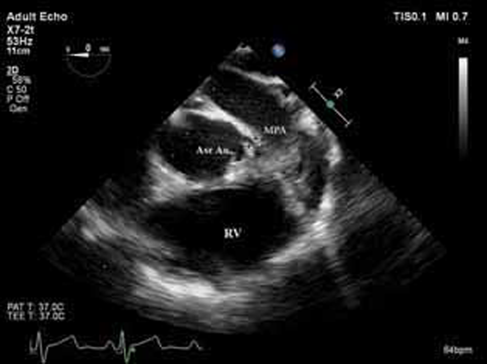 Two-dimensional transesophageal echocardiography (2D TEE), midesophageal ascending aortic short axis (SA) view, showed left main coronary artery (LMCA) course (arrows) between ascending aorta (Asc Ao) and pulmonary artery (PA). RV, right ventricle; MPA, main pulmonary artery.