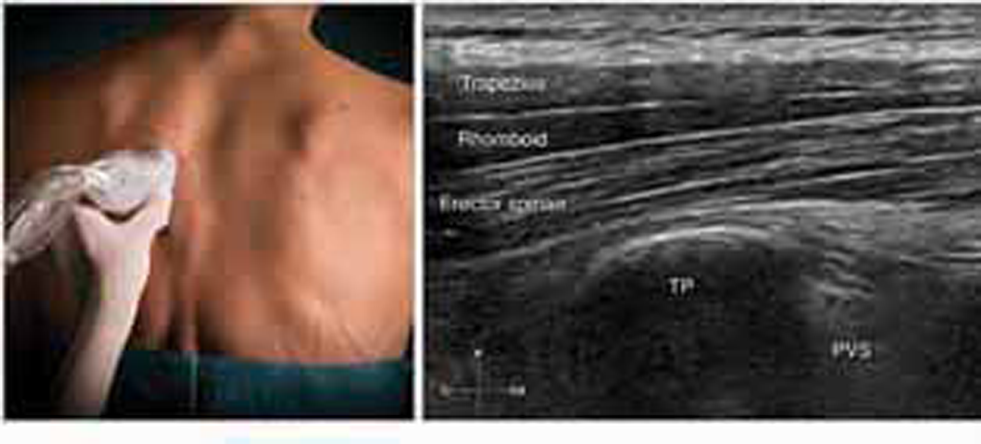 Position of ultrasound probe and sonographic visualization of muscle layer.