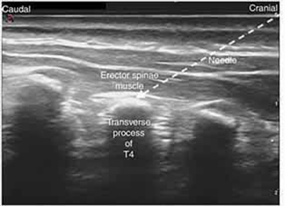 Position of needle tip between erector spinae plane (ESP) muscle and transverse process.