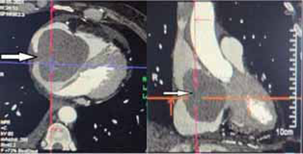 Contrast-enhanced CT image showing mass occupying whole of right atrium (RA) (white arrow).